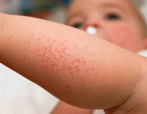 Atopic dermatitis (AD) is a long-term (chronic) skin condition that causes dry, itchy skin. . Childhood rashes pictures
